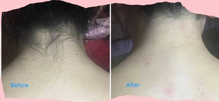 Back neck Waxing